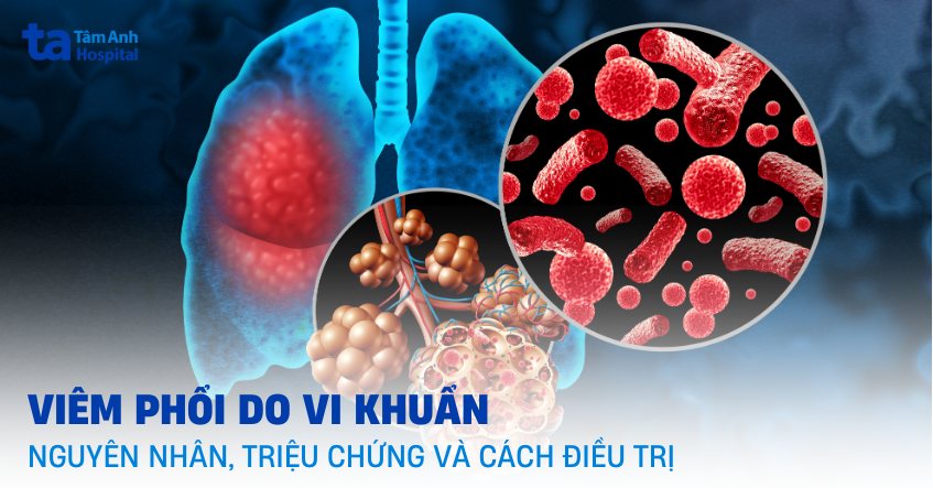 Viêm Phổi Do Vi Khuẩn: Nguyên Nhân, Triệu Chứng, Chẩn Đoán và Điều Trị 7 Viêm phổi do vi khuẩn là gì
