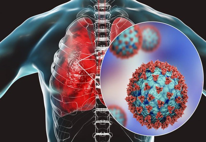 viêm phổi do virus