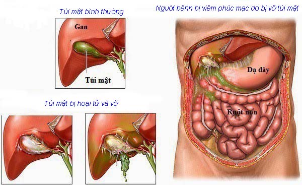 Viêm phúc mạc cấp