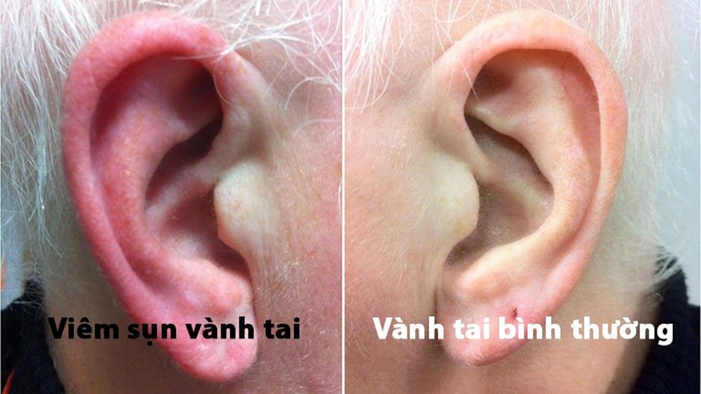 hình ảnh minh họa viêm sụn vành tai