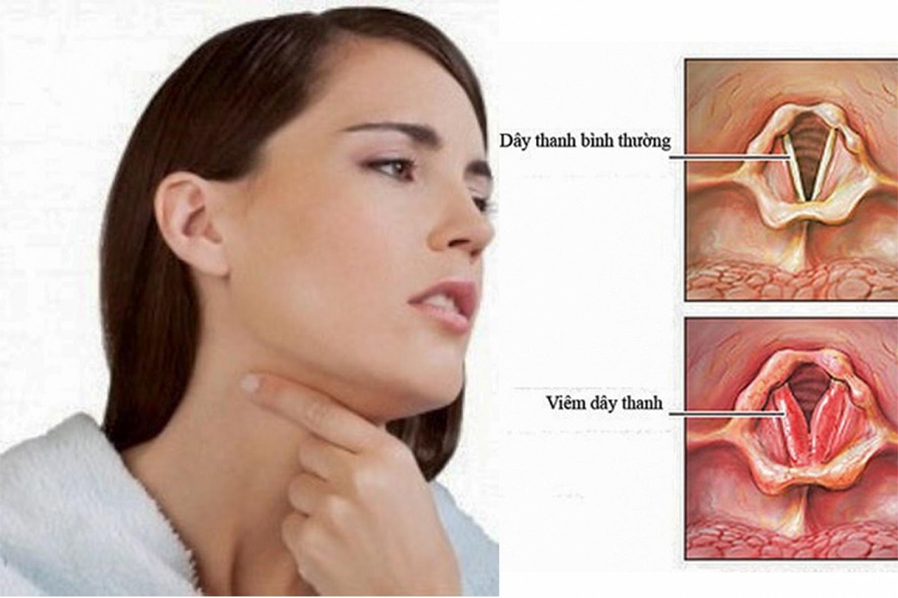 Nguyên nhân viêm thanh quản mạn tính