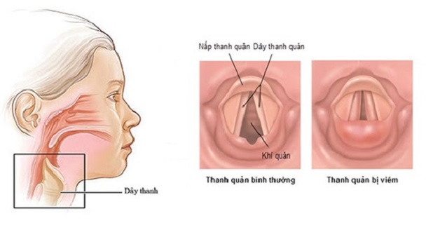 Hình ảnh viêm thanh quản mạn tính