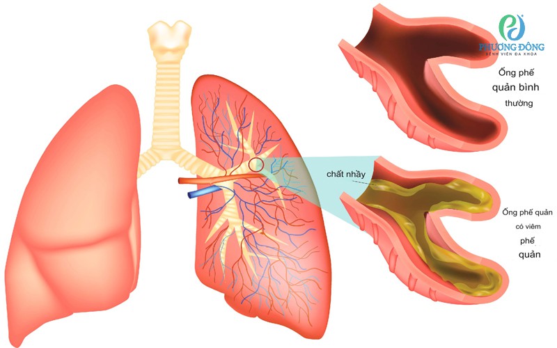 Triệu chứng viêm tiểu phế quản