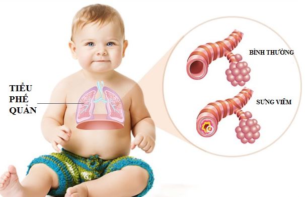Viêm tiểu phế quản ở trẻ nhỏ