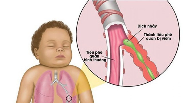 Viêm toàn tiểu phế quản lan tỏa: Nguyên nhân, triệu chứng và điều trị 7 Hình ảnh X-quang viêm tiểu phế quản ở trẻ