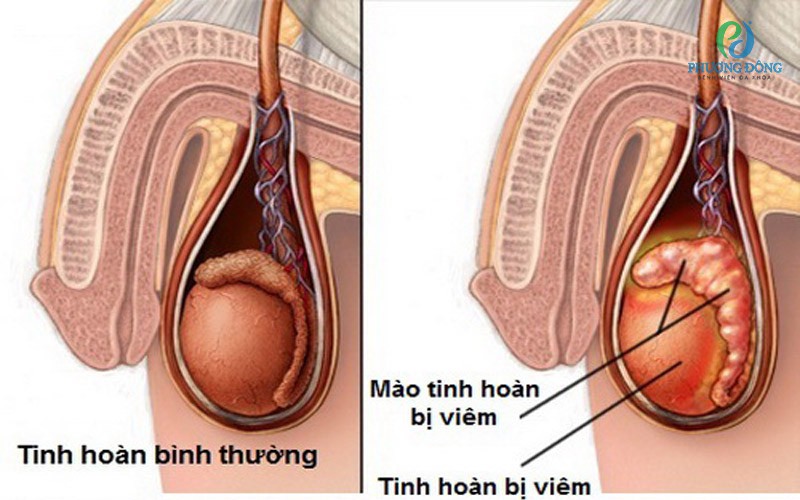 Viêm tinh hoàn do quai bị ở người lớn