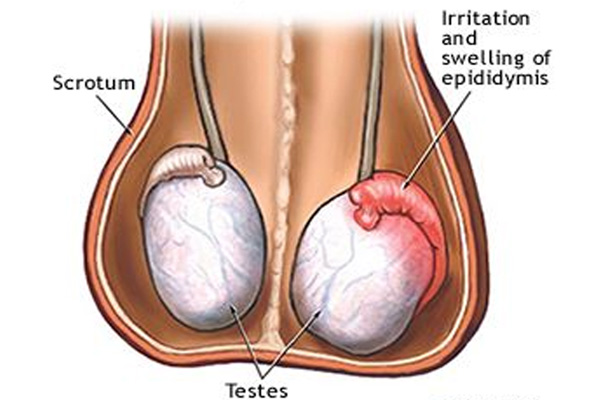 Hình ảnh viêm tinh hoàn sau quai bị