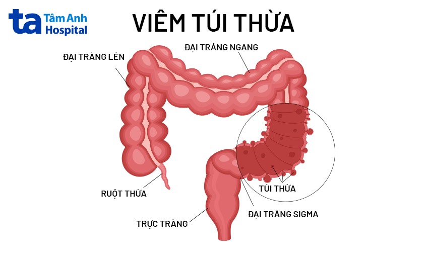 Túi thừa đại tràng bị viêm