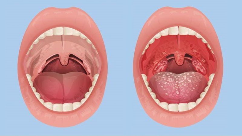 triệu chứng bệnh do virus parainfluenza