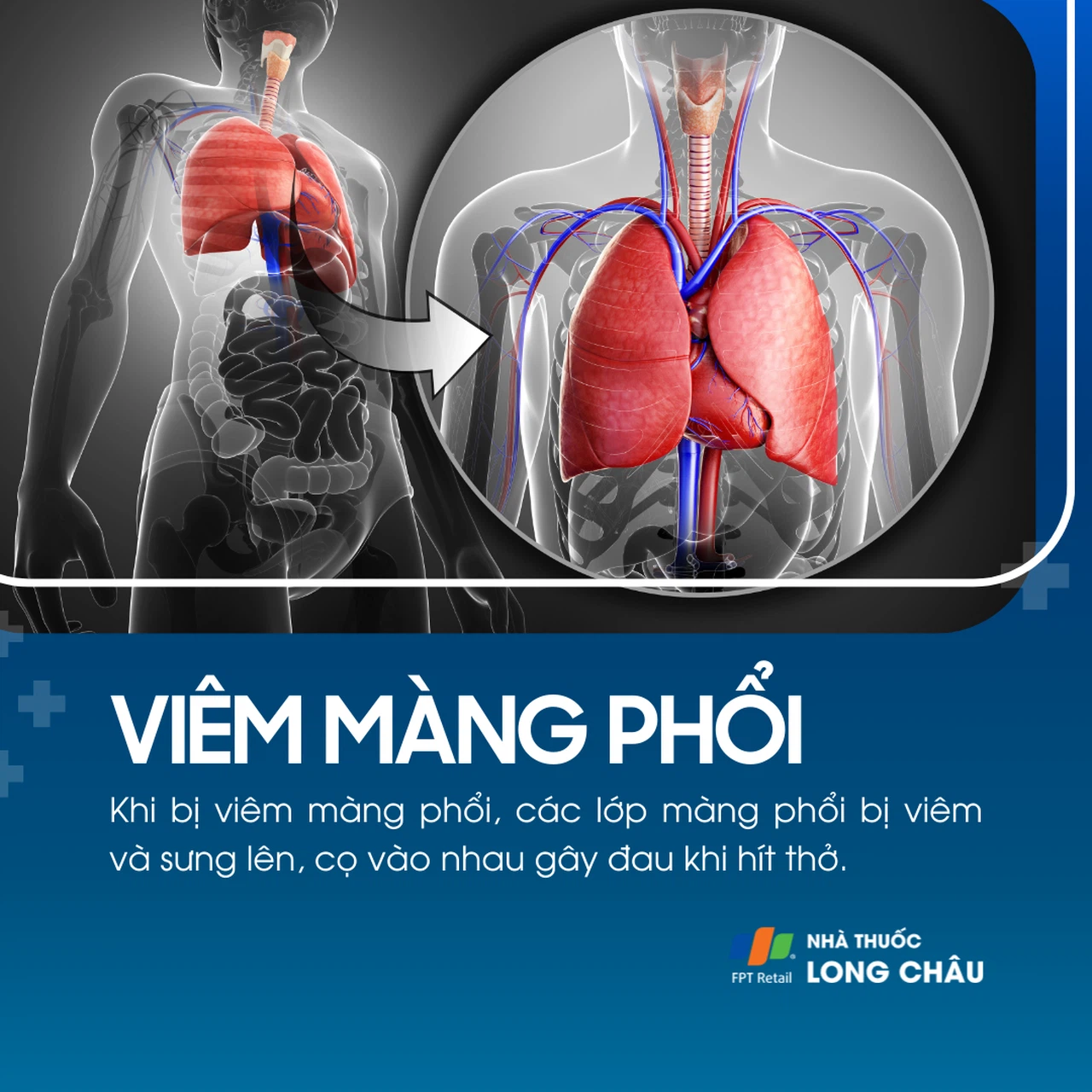 Viêm màng phổi dạng thấp hình ảnh minh họa