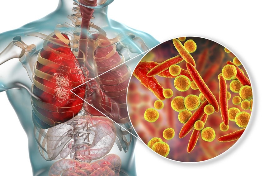 Viêm phổi tăng cảm là bệnh viêm phổi dị ứng ngoại lai