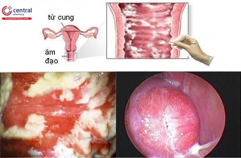 Viêm âm đạo do nấm Candida