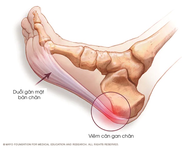 Nguyên nhân viêm cân gan chân