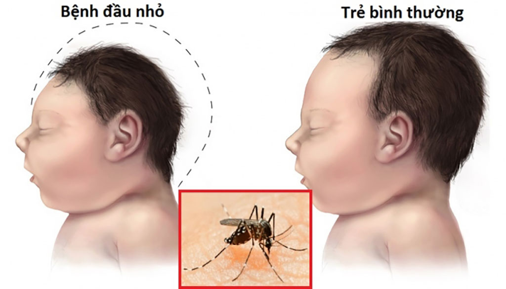 Virus Zika gây dị tật đầu nhỏ
