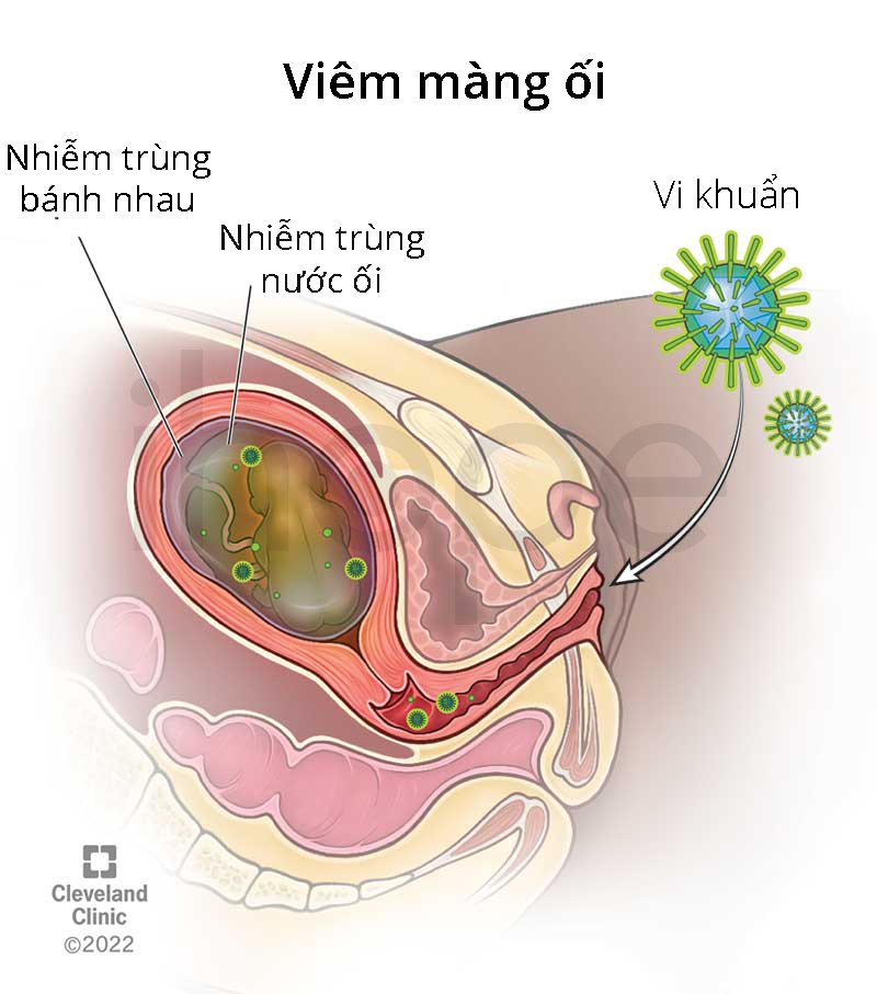 Viêm màng ối là gì