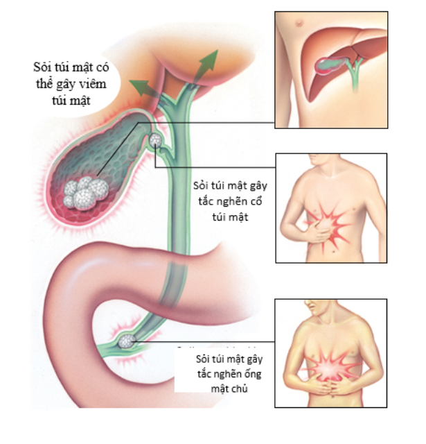 siêu âm chẩn đoán viêm túi mật
