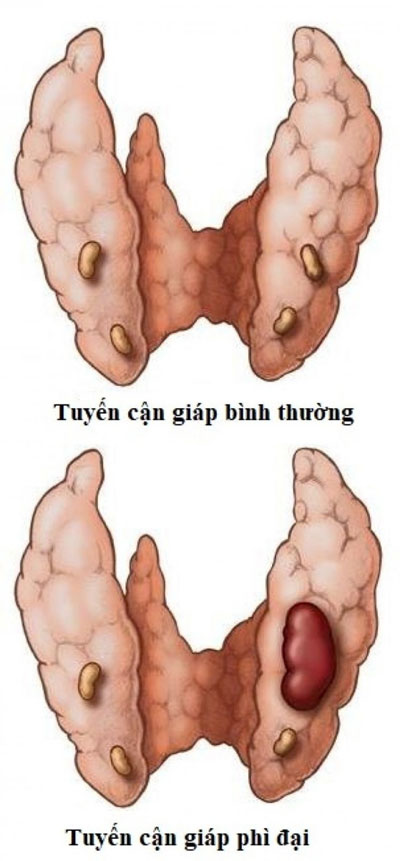 Cường cận giáp thứ phát