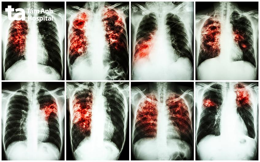 Viêm phổi tổ chức hóa: Nguyên nhân, triệu chứng và cách điều trị hiệu quả 7 X-quang phổi mô kẽ tổ chức hóa