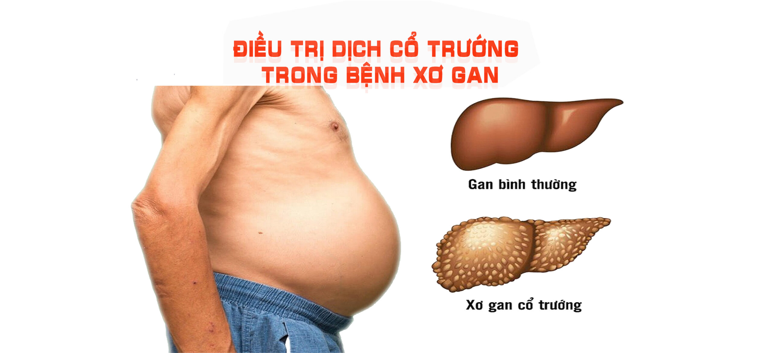 Xơ gan gây cổ trướng