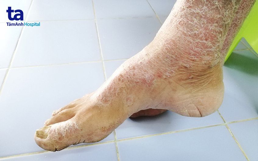 Hình ảnh bệnh nhân xơ cứng bì toàn thể