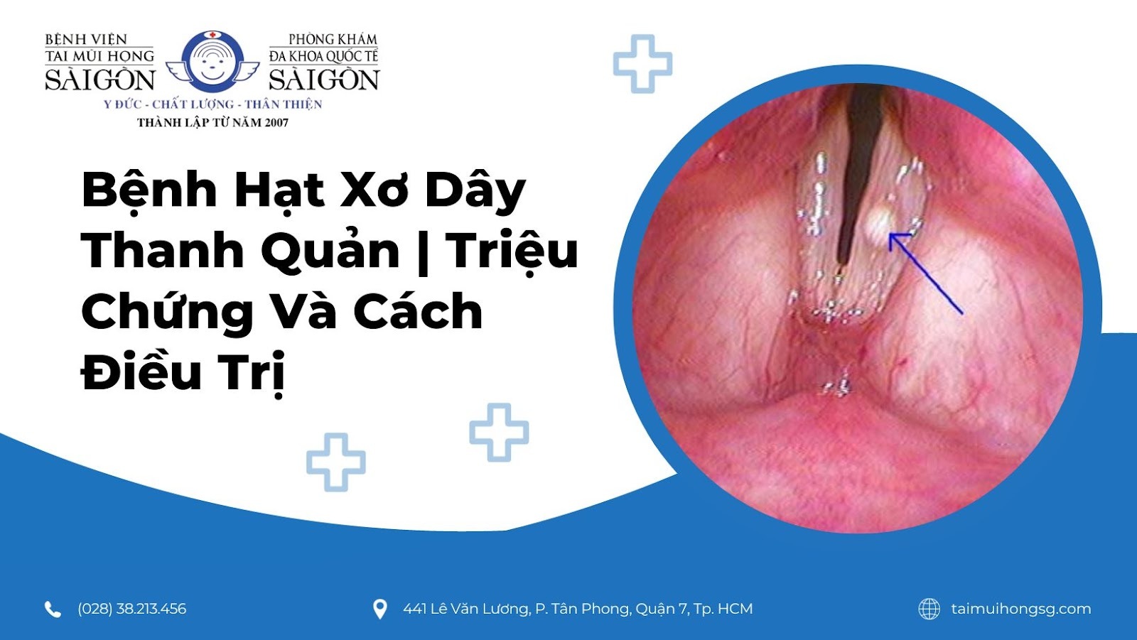 Nội soi phát hiện hạt dây thanh