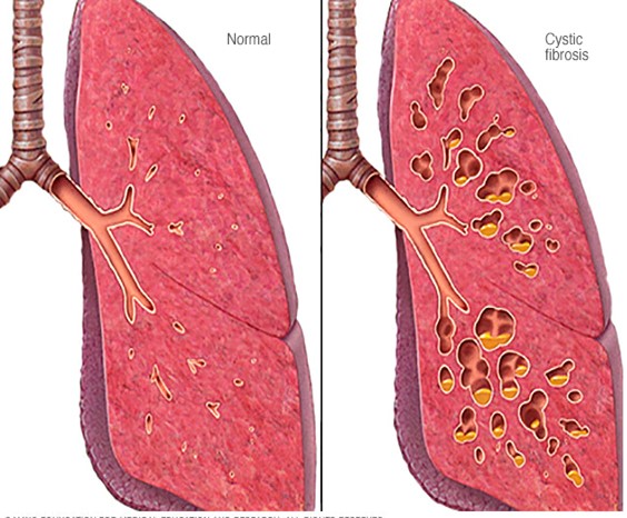 Bệnh xơ nang: Nguyên nhân, triệu chứng, chẩn đoán và điều trị 7 xơ nang phổi
