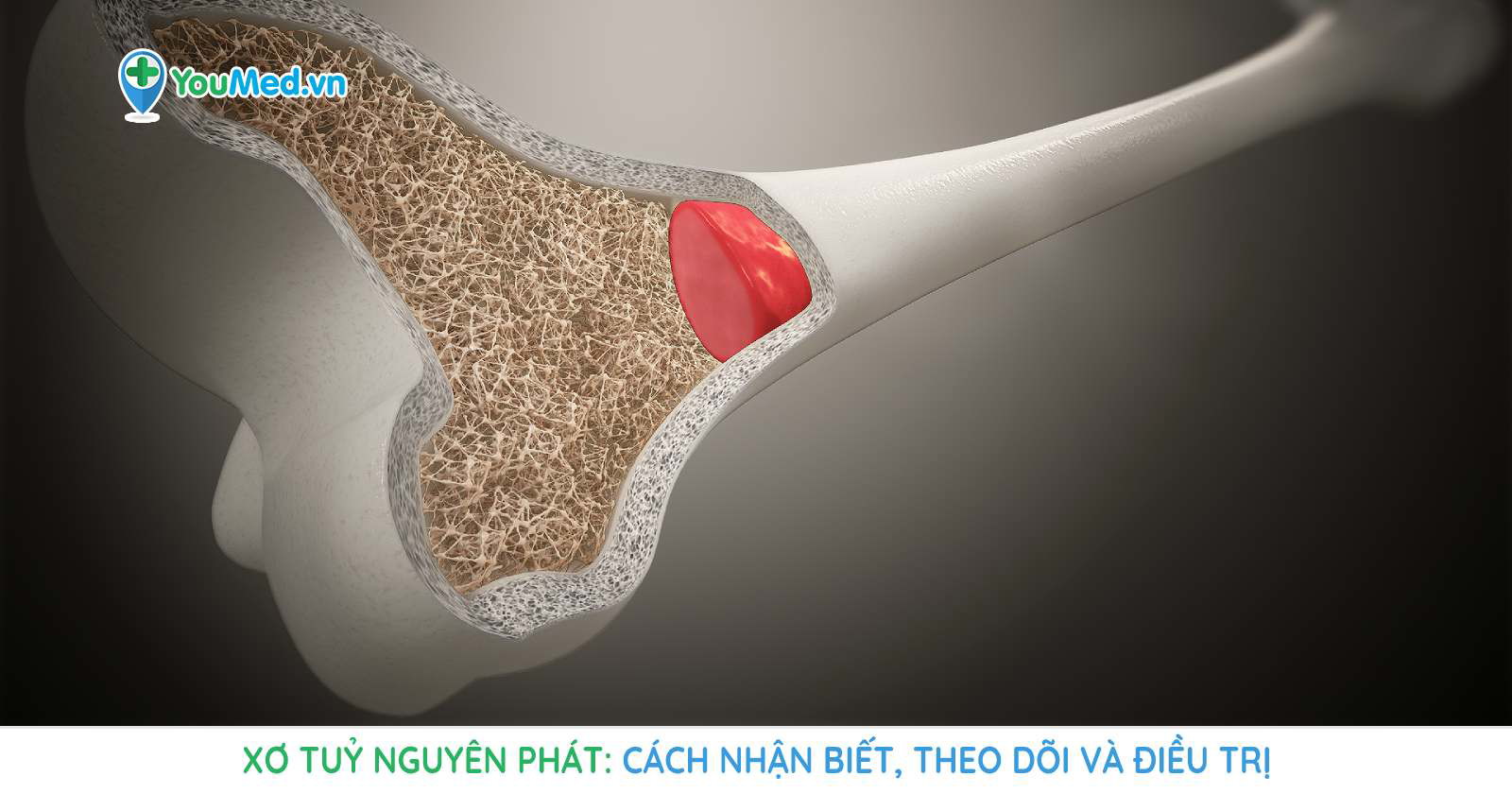 Hình ảnh bệnh xơ tủy nguyên phát