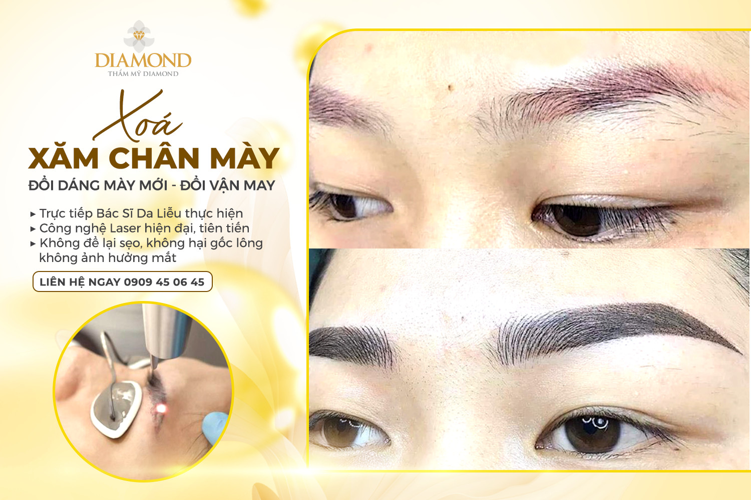 Trước khi xóa xăm chân mày bằng laser