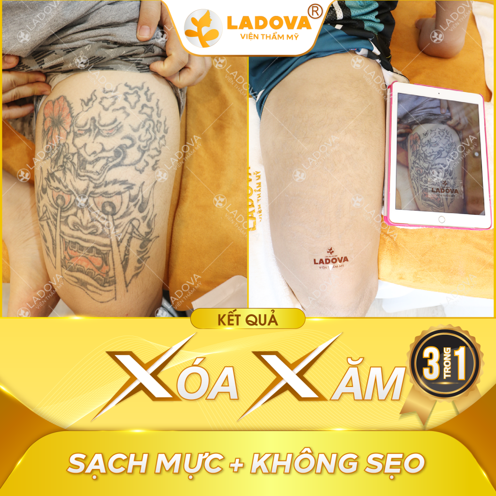 Hình ảnh thực tế sau xóa xăm bằng Pico laser