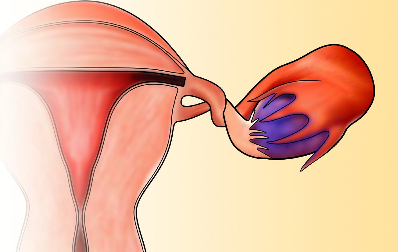 Hình ảnh xoắn buồng trứng