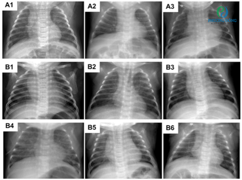 X-quang phổi trẻ sơ sinh bị BPD