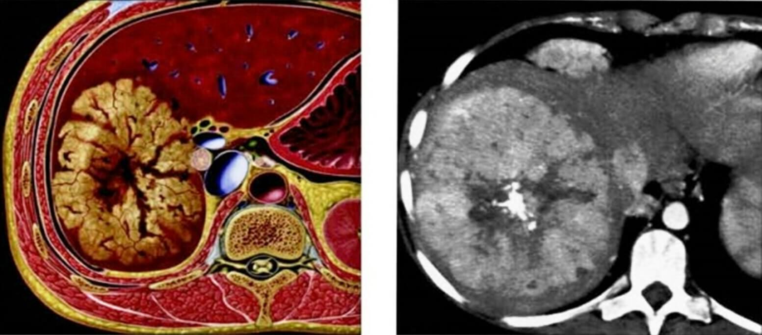 Hình ảnh khối u gan trên CT Scan