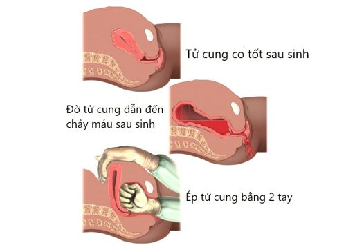 Xử trí đờ tử cung cấp cứu