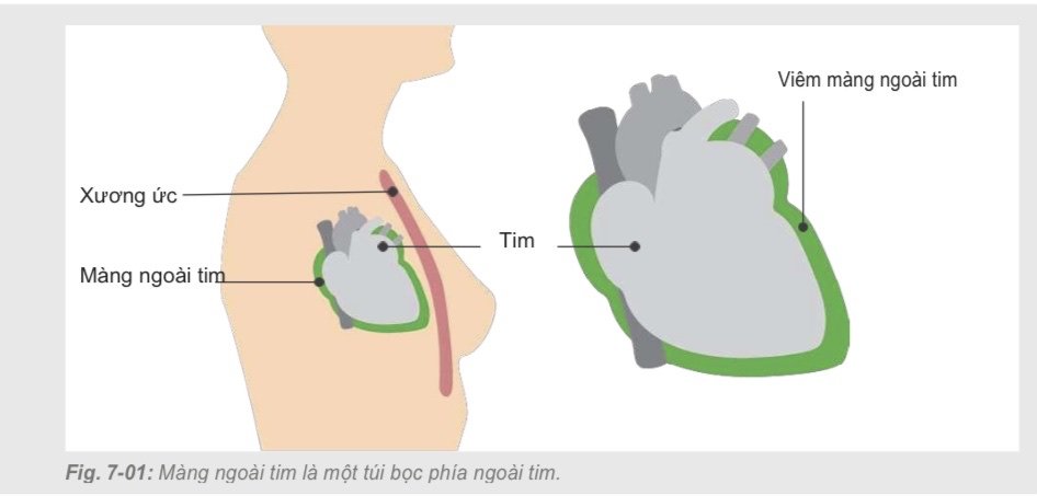 siêu âm màng ngoài tim bị viêm
