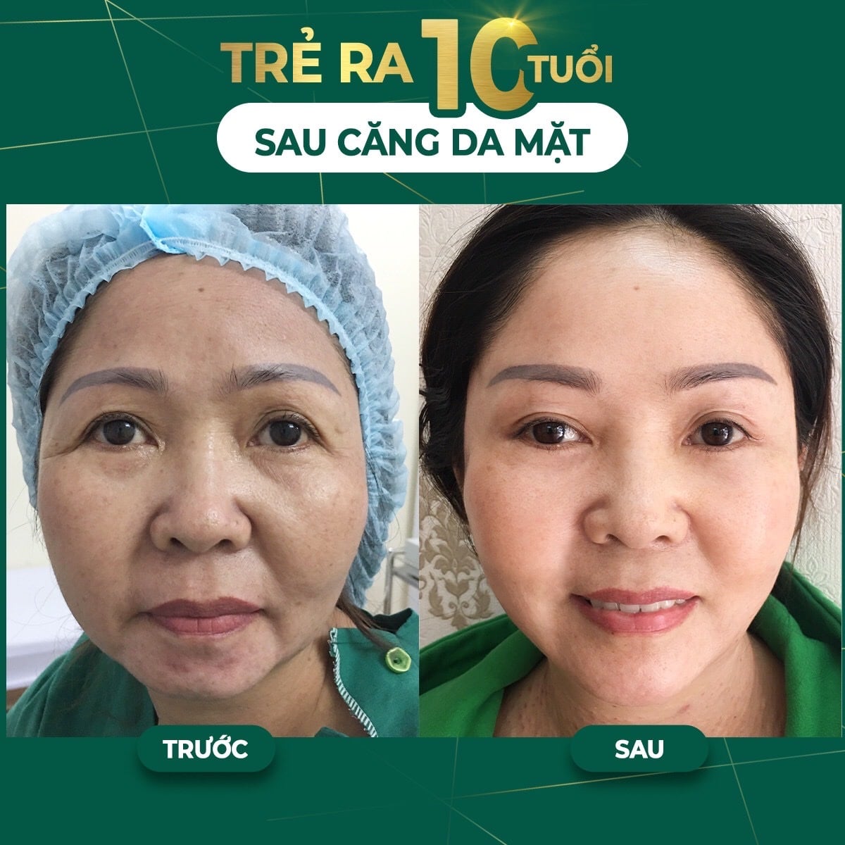 Căng chỉ trẻ hóa da