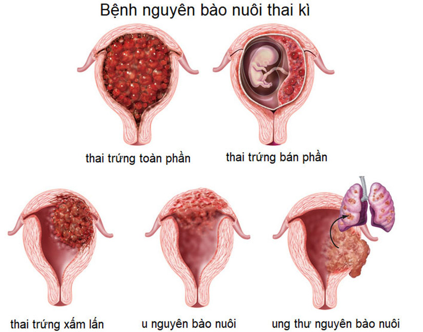 Hình ảnh siêu âm chửa trứng