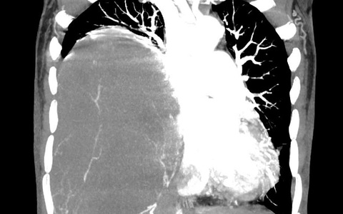 Hình ảnh CT scan u sợi màng phổi