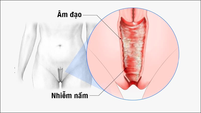 Nhiễm trùng tái phát thường xuyên: Nguyên nhân, Điều trị và Cách phòng ngừa hiệu quả 7 Nhiễm trùng tái phát thường xuyên