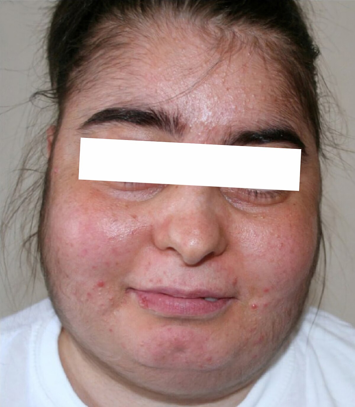 Mặt tròn như mặt trăng trong hội chứng Cushing