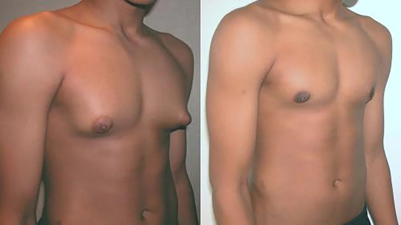 vú to ở nam giới gynecomastia