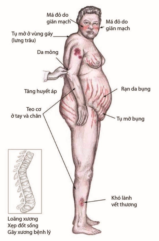 loạn dưỡng mỡ thân mình tay chân teo