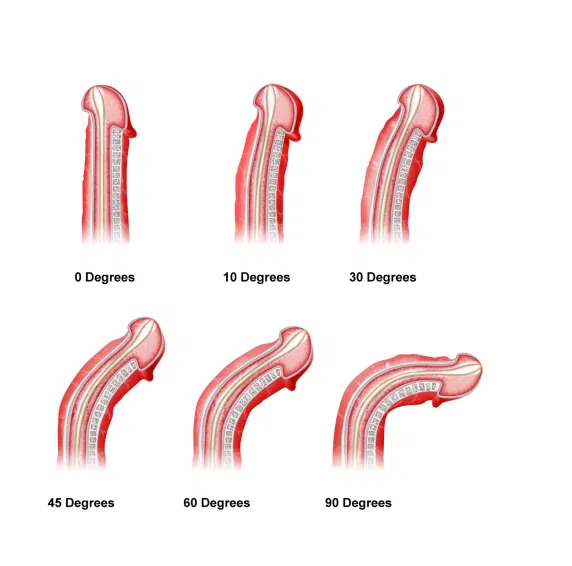 bệnh Peyronie, cấu trúc dương vật