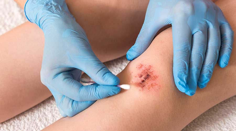 Chăm sóc vết thương lâu lành đúng cách
