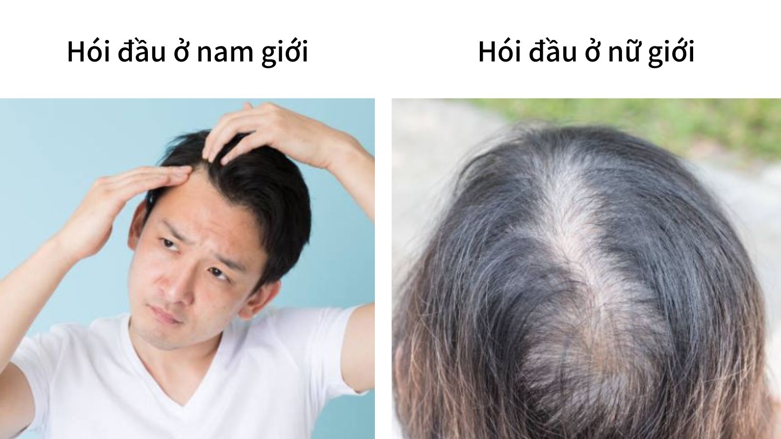 Hói đầu kiểu nam ở nữ: Nguyên nhân, dấu hiệu và phương pháp điều trị 7 Hói đầu kiểu nam ở nữ