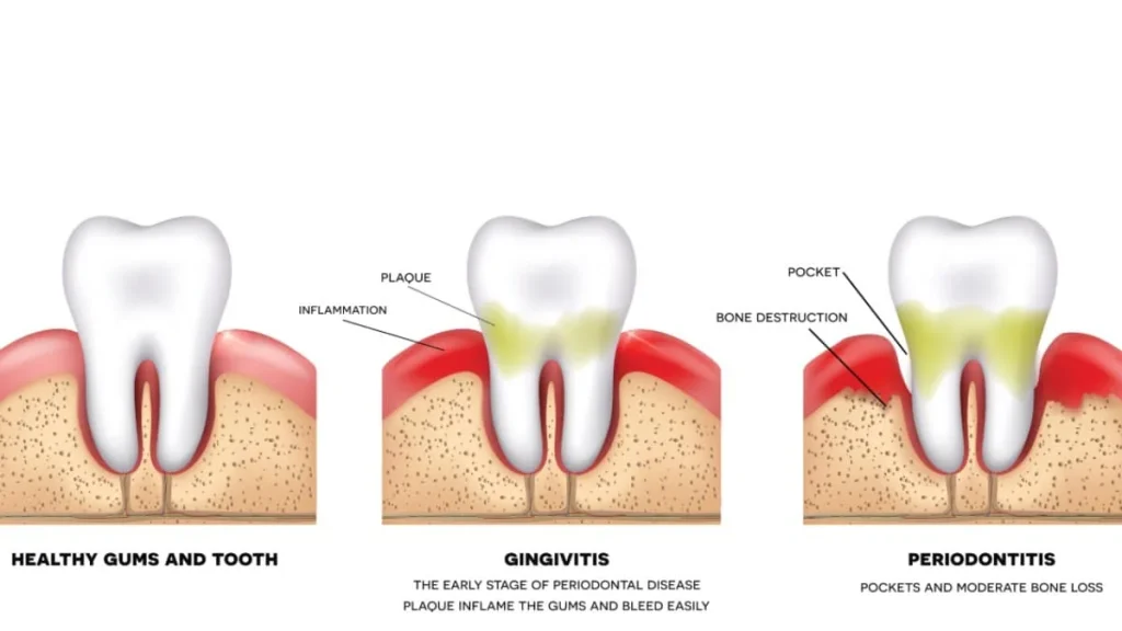 Chảy Máu Nướu Răng Tự Nhiên – Nguyên Nhân, Triệu Chứng, Điều Trị và Phòng Ngừa 7 Chảy máu nướu răng