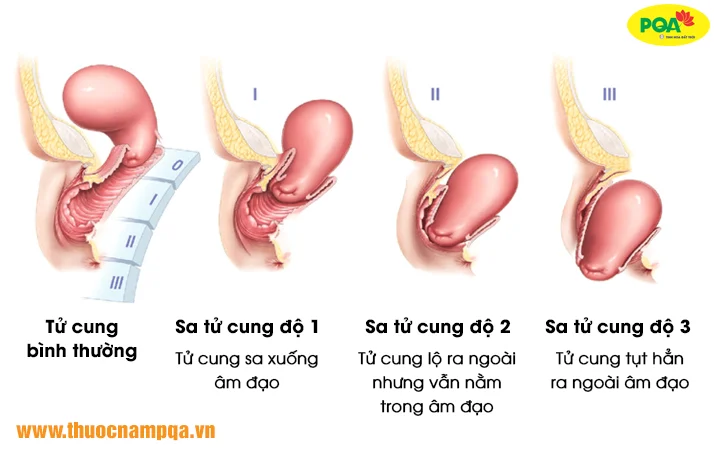 Các cấp độ sa tử cung