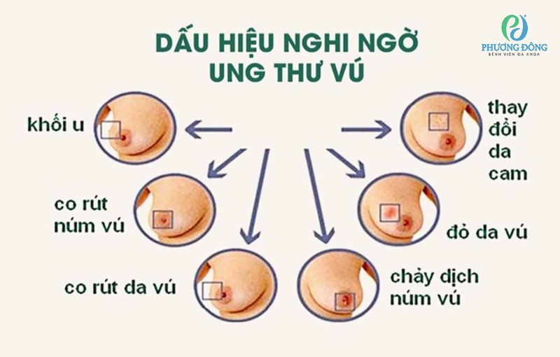 Dấu hiệu ung thư vú