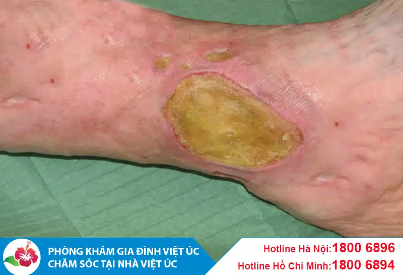 Dấu hiệu vết thương bị nhiễm trùng