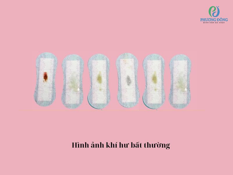 Khí hư màu vàng
