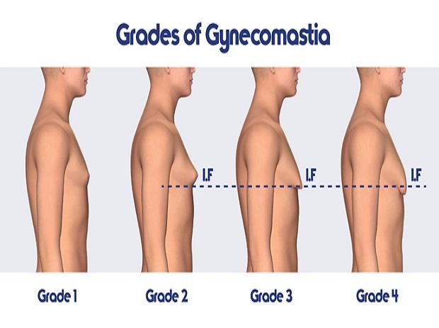 nữ hóa tuyến vú ở nam giới